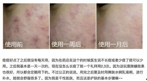 明星网红用的痘痘贴,明星同款痘痘贴，轻松遮瑕美肌秘籍